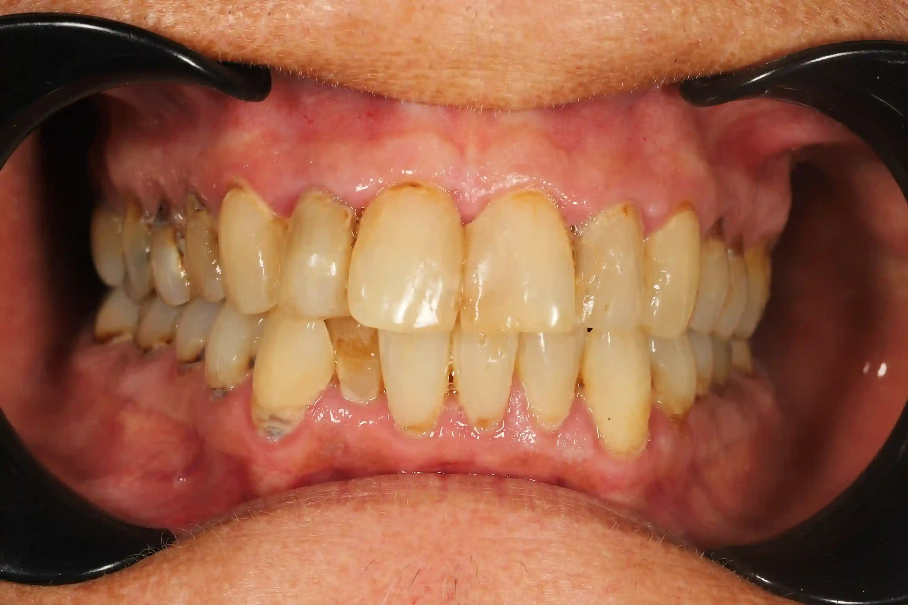 Dental Implants - Before