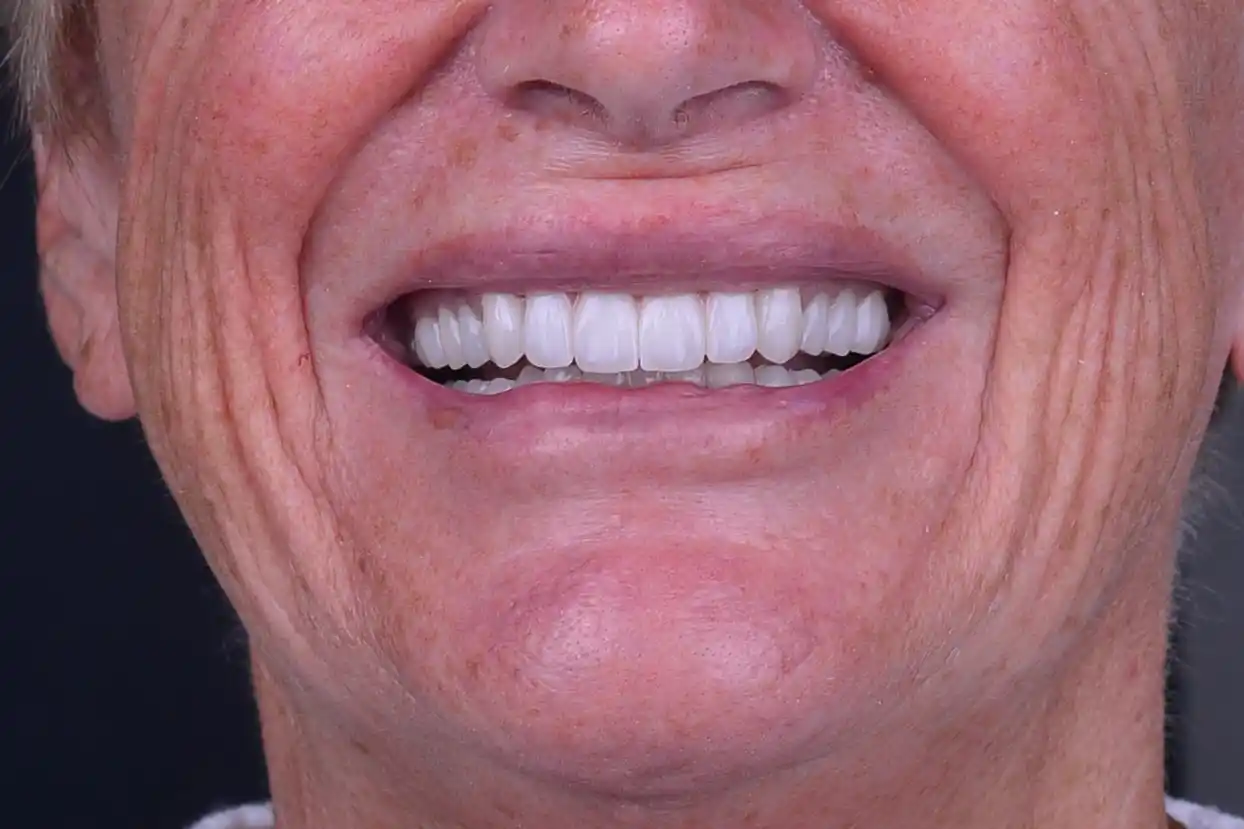 Smile Makeover - After
