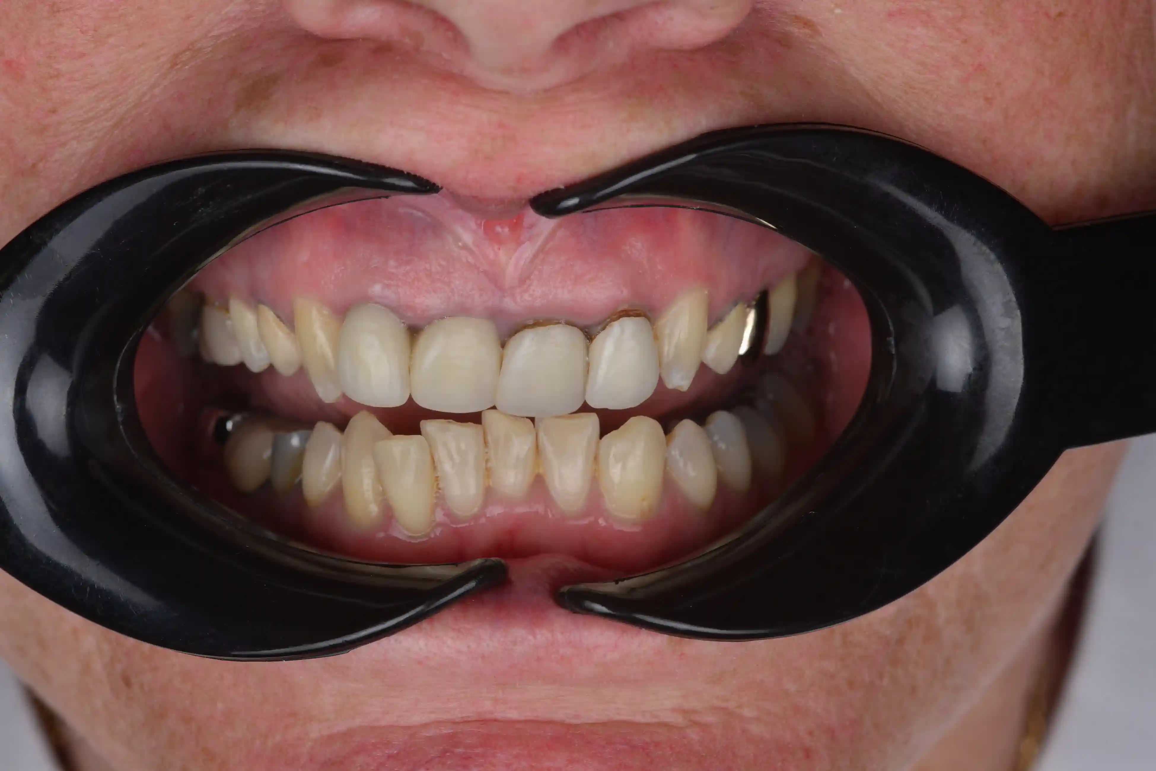 Smile Makeover - Before